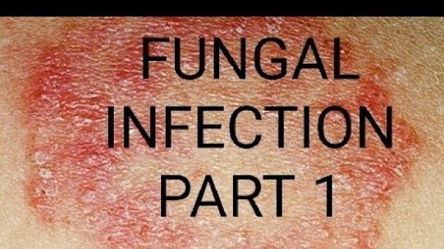 '#best Fungal Infection Video #Itracanazole Capsule #Fungal Infection#health and fitness store'