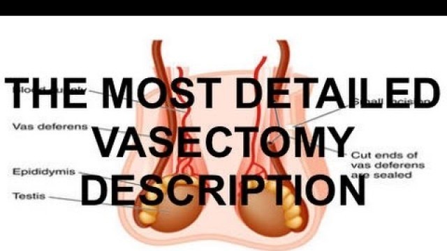 'Vasectomy | What to Expect Before, During and After the Vasectomy | Tiger Fitness'