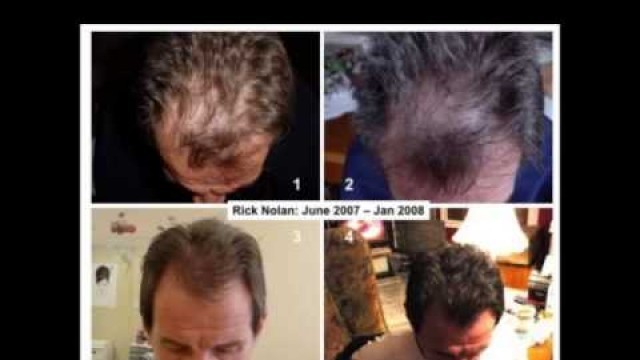 'Nu Skin Nutriol Hair Fitness Treatment Before & After Photos!!!!'